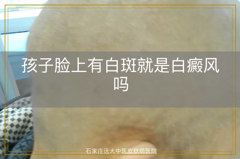 孩子脸上有白斑就是白癜风吗