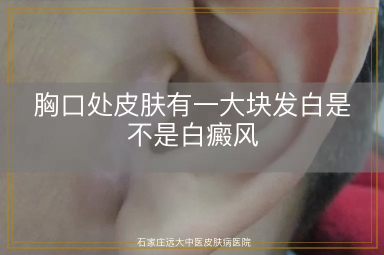 胸口处皮肤有一大块发白是不是白癜风