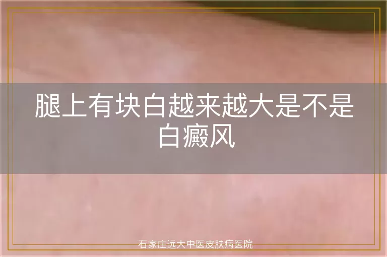 腿上有块白越来越大是不是白癜风