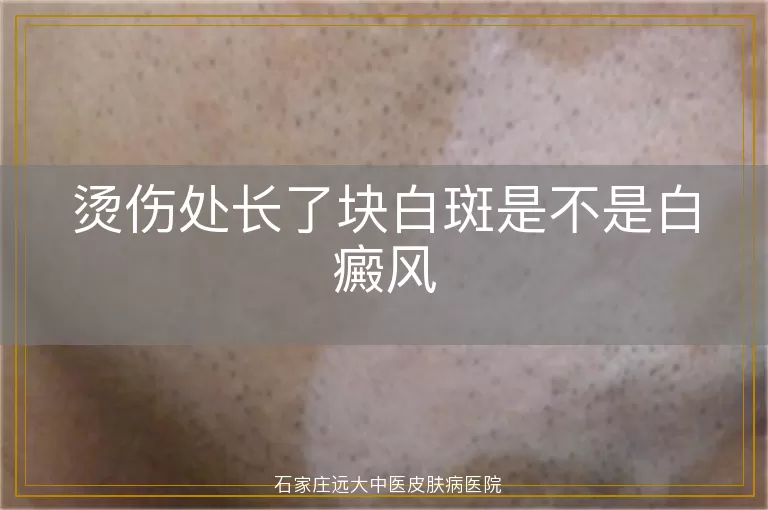 烫伤处长了块白斑是不是白癜风