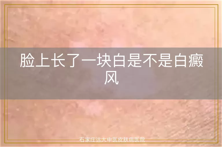 脸上长了一块白是不是白癜风