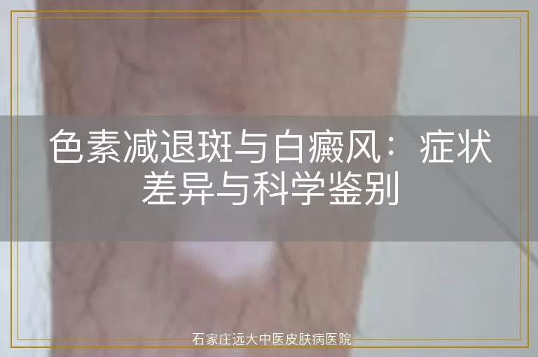 色素减退斑与白癜风：症状差异与科学鉴别