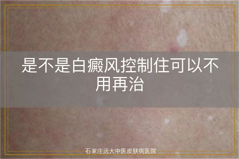 是不是白癜风控制住可以不用再治