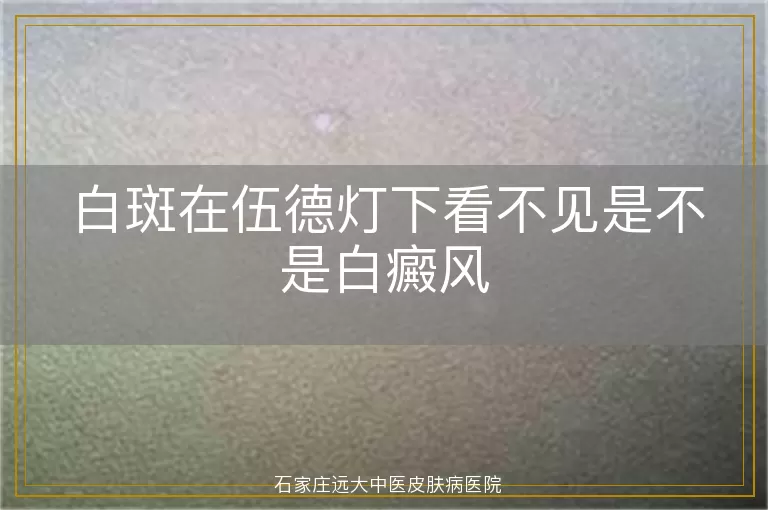 白斑在伍德灯下看不见是不是白癜风