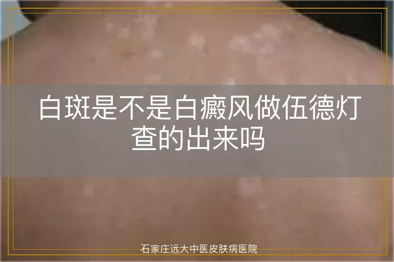 白斑是不是白癜风做伍德灯查的出来吗