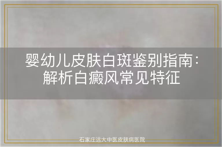 婴幼儿皮肤白斑鉴别指南：解析白癜风常见特征