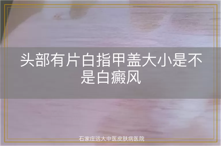 头部有片白指甲盖大小是不是白癜风