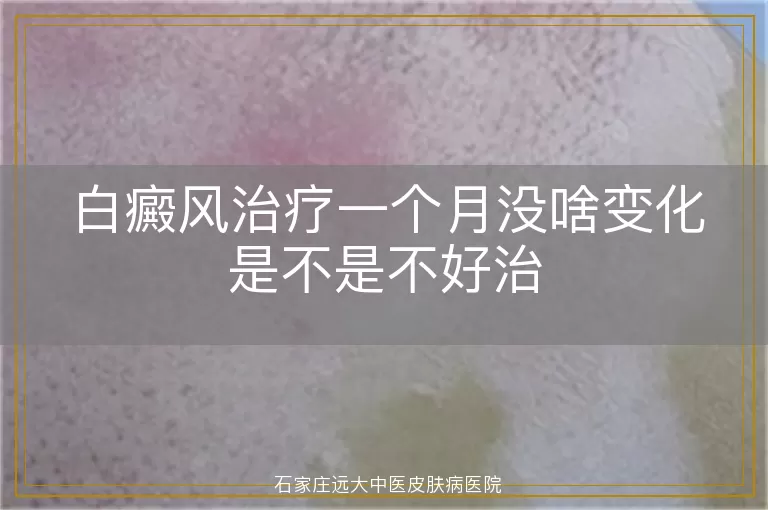 白癜风治疗一个月没啥变化是不是不好治