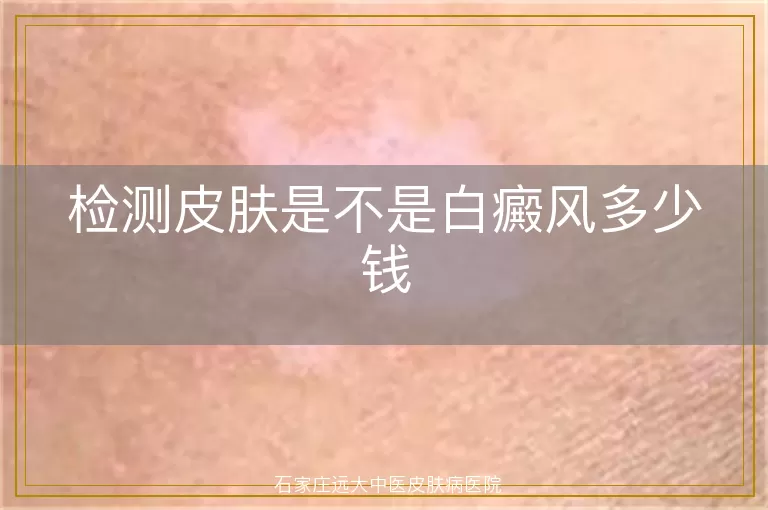 检测皮肤是不是白癜风多少钱