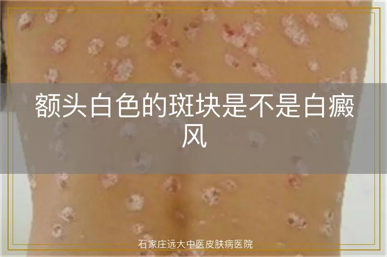 额头白色的斑块是不是白癜风