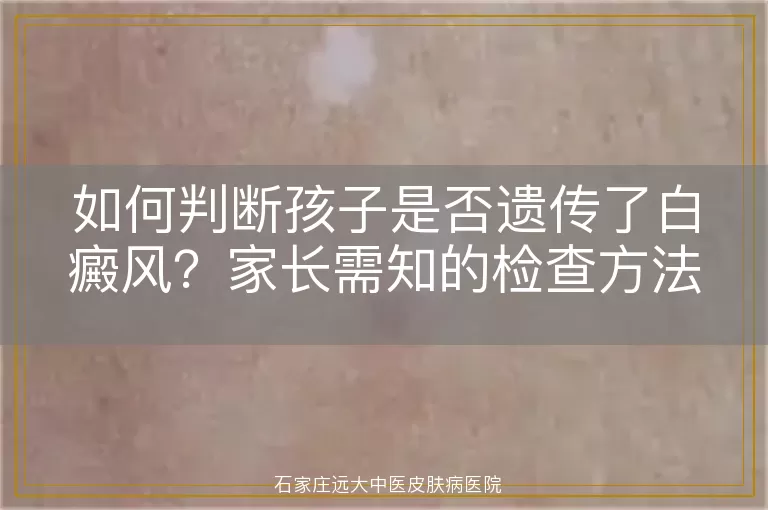 如何判断孩子是否遗传了白癜风？家长需知的检查方法