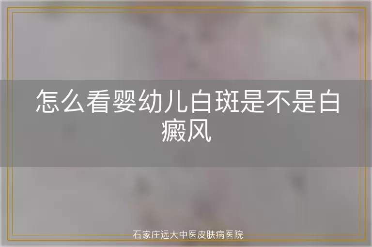 怎么看婴幼儿白斑是不是白癜风