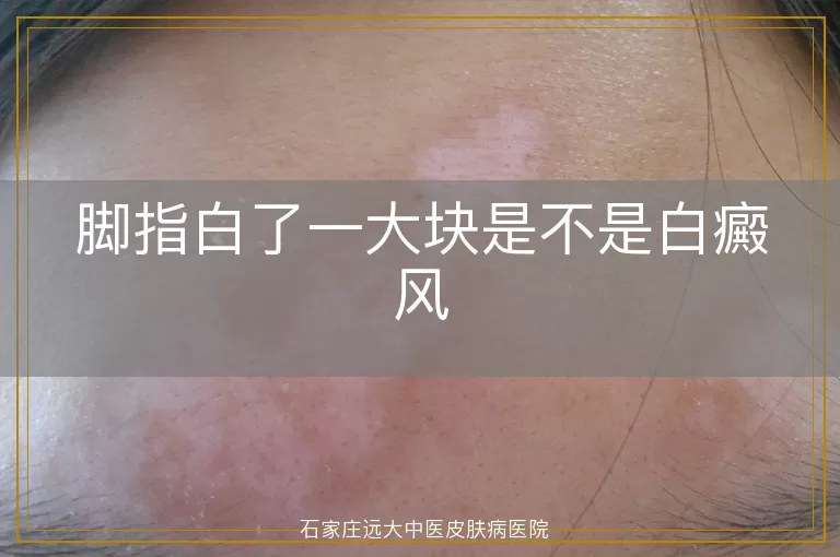 脚指白了一大块是不是白癜风