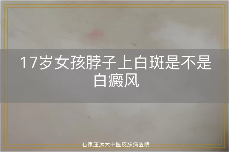 17岁女孩脖子上白斑是不是白癜风