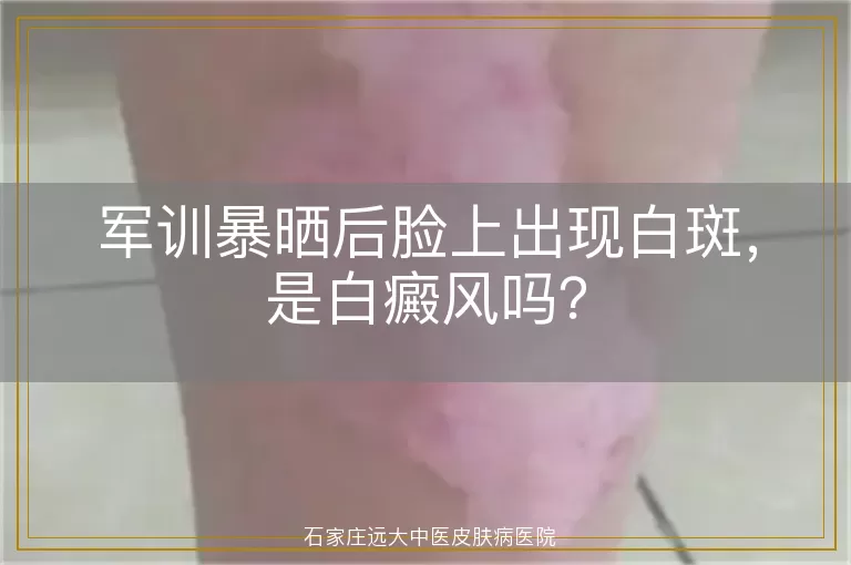 军训暴晒后脸上出现白斑，是白癜风吗？