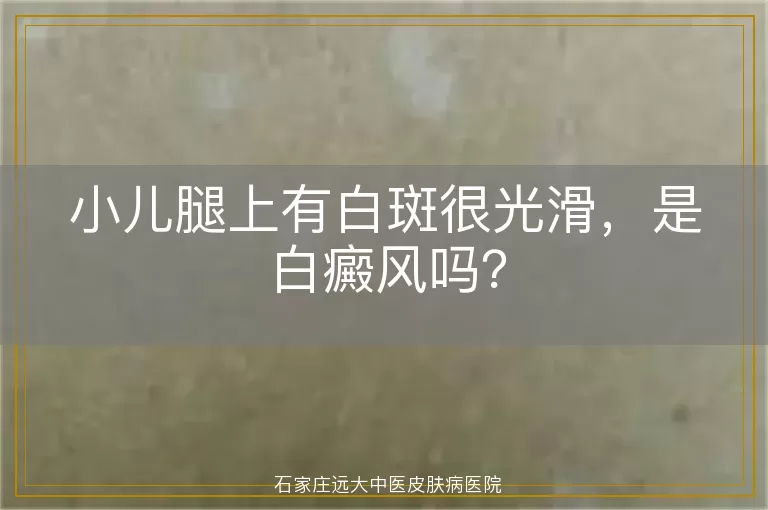 小儿腿上有白斑很光滑，是白癜风吗？