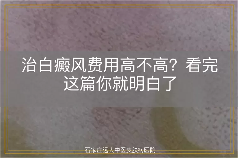 治白癜风费用高不高？看完这篇你就明白了
