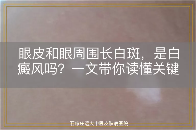 眼皮和眼周围长白斑，是白癜风吗？一文带你读懂关键区别