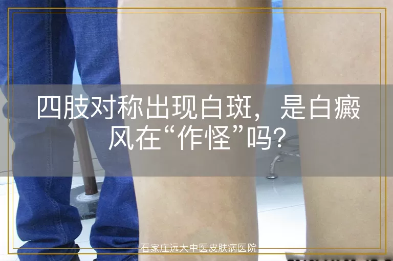 四肢对称出现白斑，是白癜风在“作怪”吗？