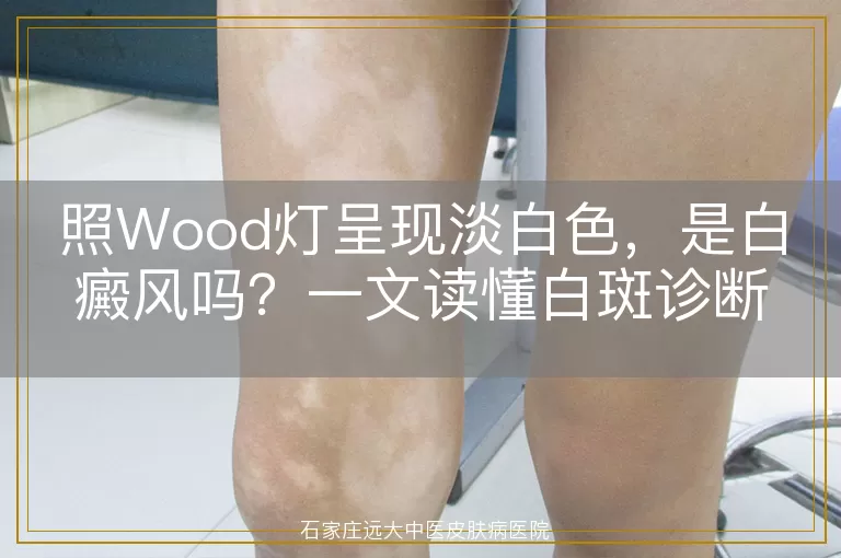 照Wood灯呈现淡白色，是白癜风吗？一文读懂白斑诊断关键
