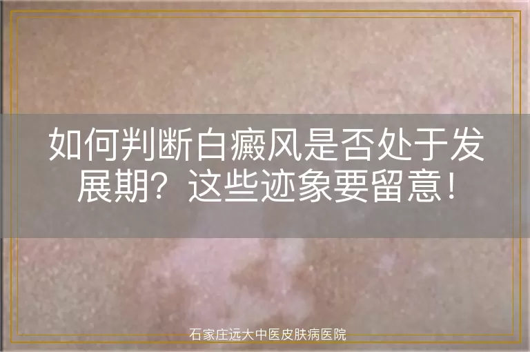 如何判断白癜风是否处于发展期？这些迹象要留意！