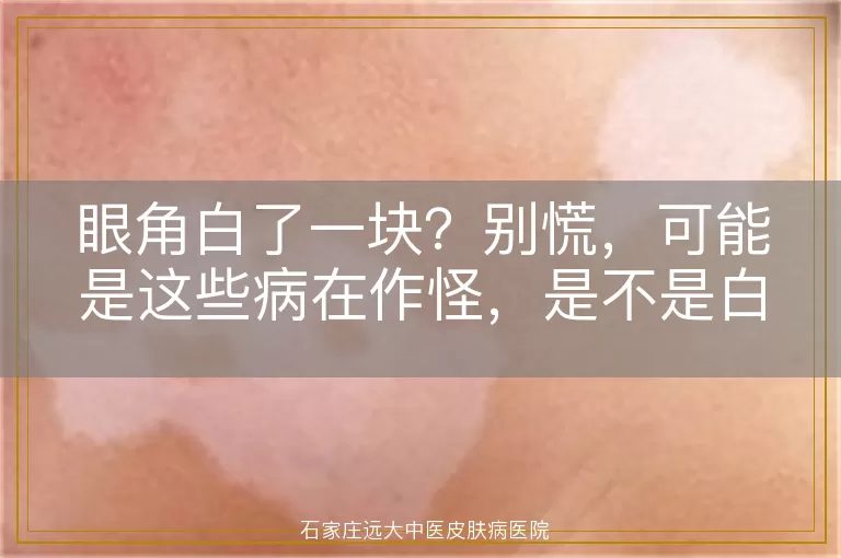 眼角白了一块？别慌，可能是这些病在作怪，是不是白癜风看这里