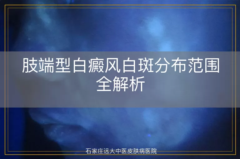 肢端型白癜风白斑分布范围全解析