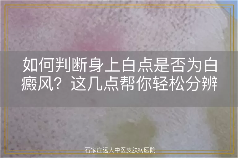 如何判断身上白点是否为白癜风？这几点帮你轻松分辨