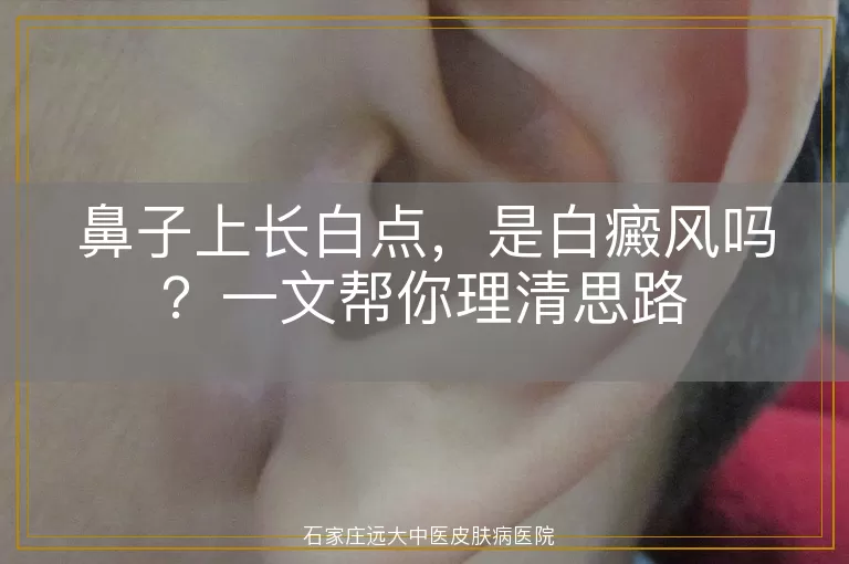 鼻子上长白点，是白癜风吗？一文帮你理清思路