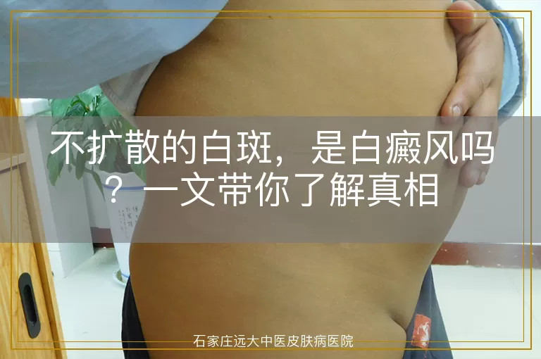 不扩散的白斑，是白癜风吗？一文带你了解真相