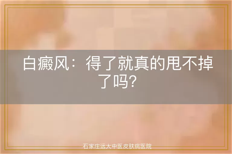 白癜风：得了就真的甩不掉了吗？