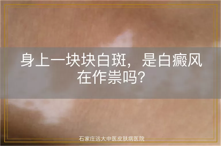 身上一块块白斑，是白癜风在作祟吗？