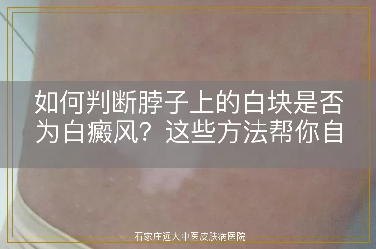 如何判断脖子上的白块是否为白癜风？这些方法帮你自查