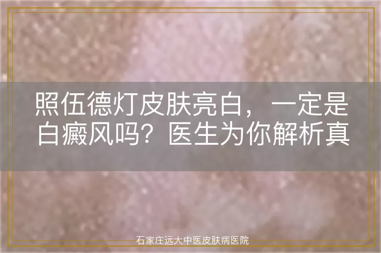 照伍德灯皮肤亮白，一定是白癜风吗？医生为你解析真相