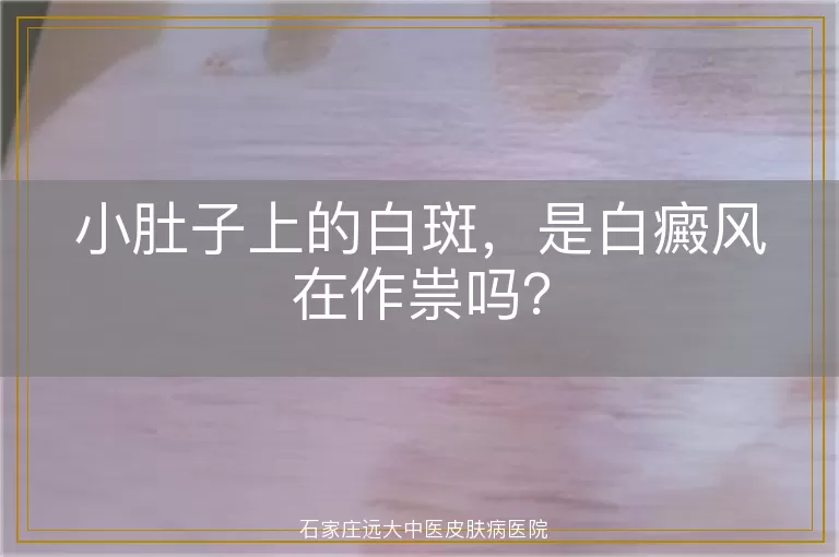 小肚子上的白斑，是白癜风在作祟吗？
