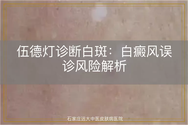 伍德灯诊断白斑：白癜风误诊风险解析