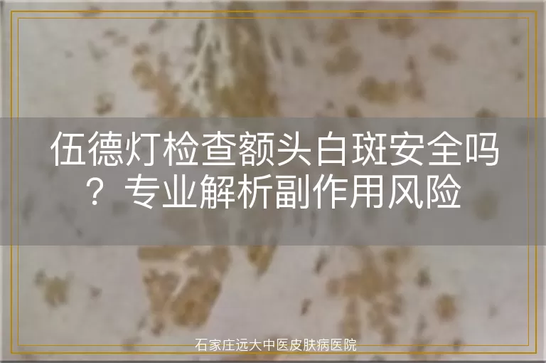 伍德灯检查额头白斑安全吗？专业解析副作用风险