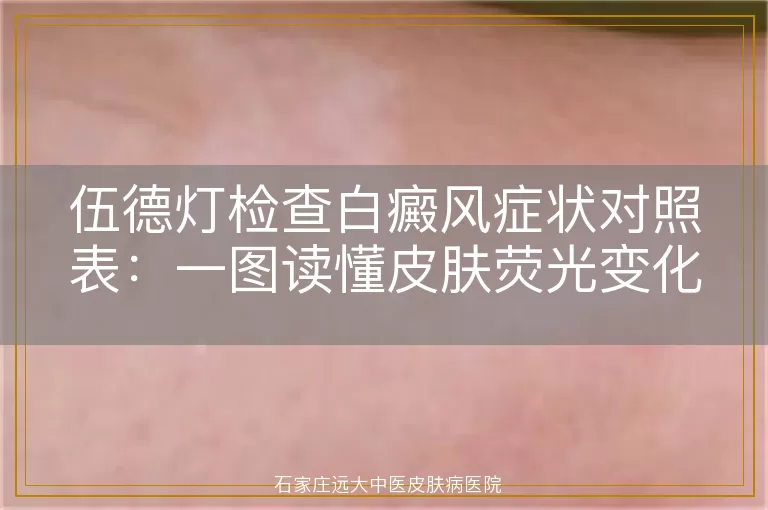 伍德灯检查白癜风症状对照表：一图读懂皮肤荧光变化