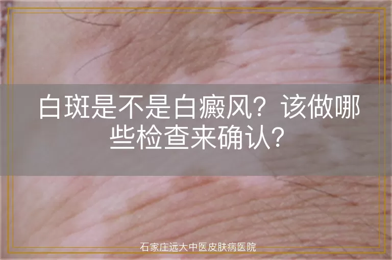 白斑是不是白癜风？该做哪些检查来确认？