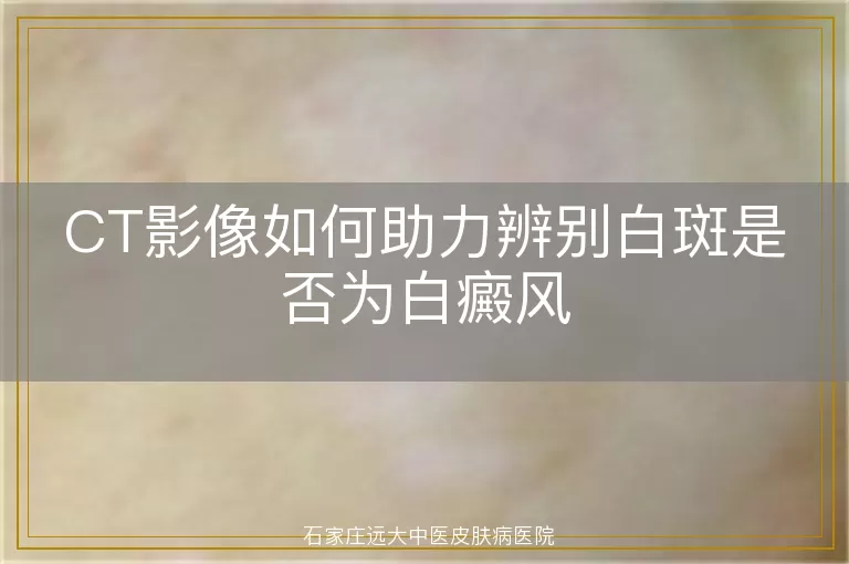 CT影像如何助力辨别白斑是否为白癜风