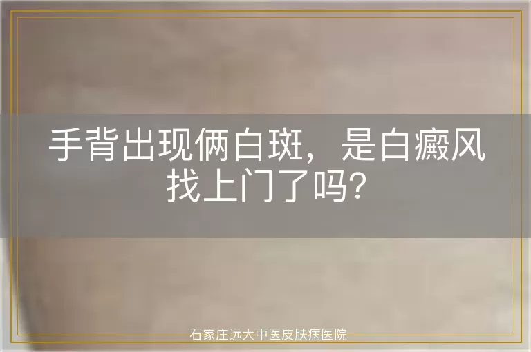 手背出现俩白斑，是白癜风找上门了吗？
