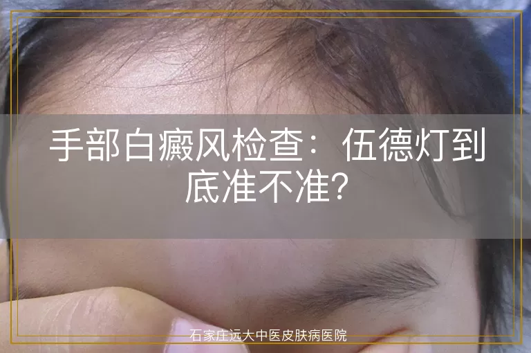 手部白癜风检查：伍德灯到底准不准？