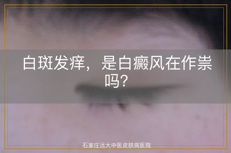 白斑发痒，是白癜风在作祟吗？