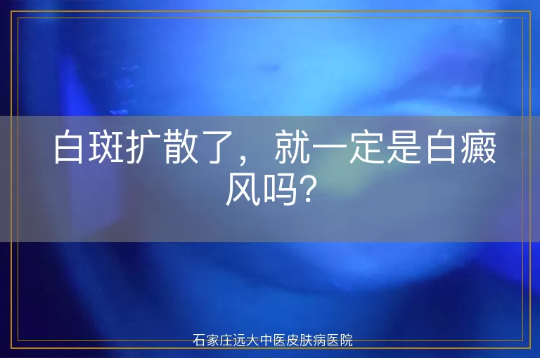 白斑扩散了，就一定是白癜风吗？