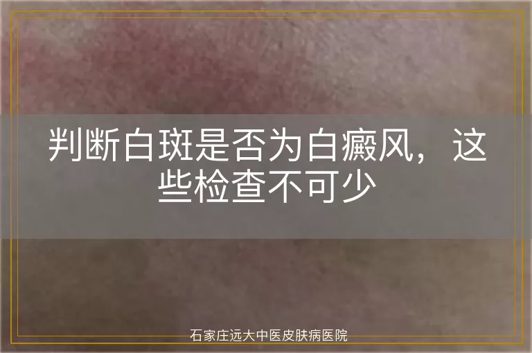 判断白斑是否为白癜风，这些检查不可少
