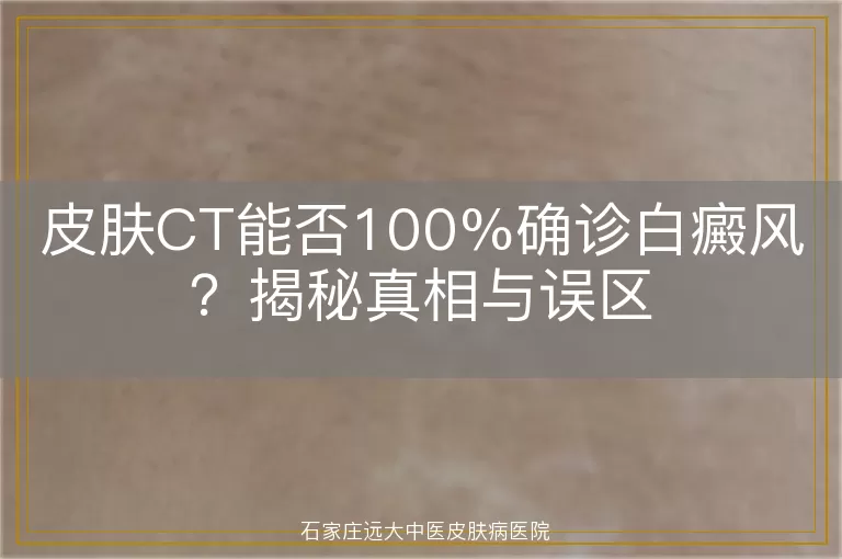 皮肤CT能否100%确诊白癜风？揭秘真相与误区