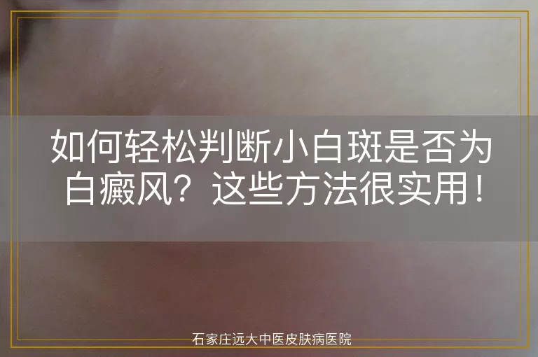 如何轻松判断小白斑是否为白癜风？这些方法很实用！