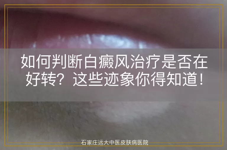 如何判断白癜风治疗是否在好转？这些迹象你得知道！