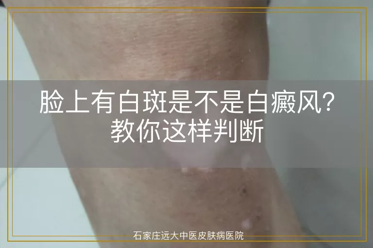 脸上有白斑是不是白癜风？教你这样判断