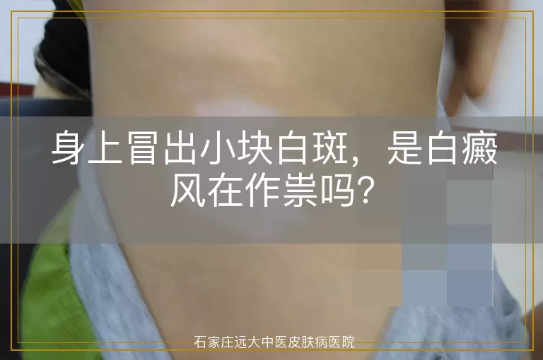 身上冒出小块白斑，是白癜风在作祟吗？